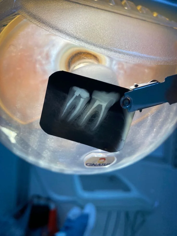 Endodoncia (Tratamiento de Conducto)