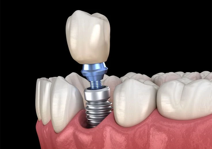 Rehabilitación Implantológica